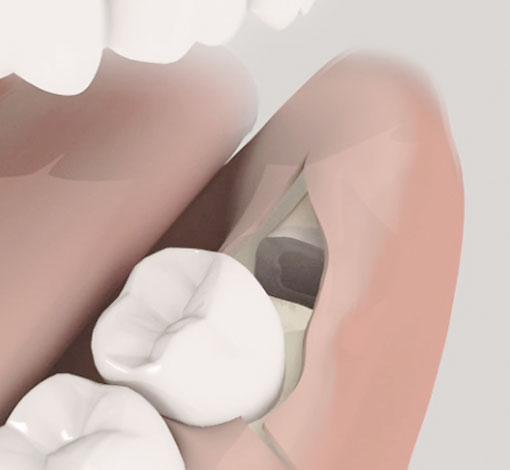 Entfernung eines verlagerten Weisheitszahnes